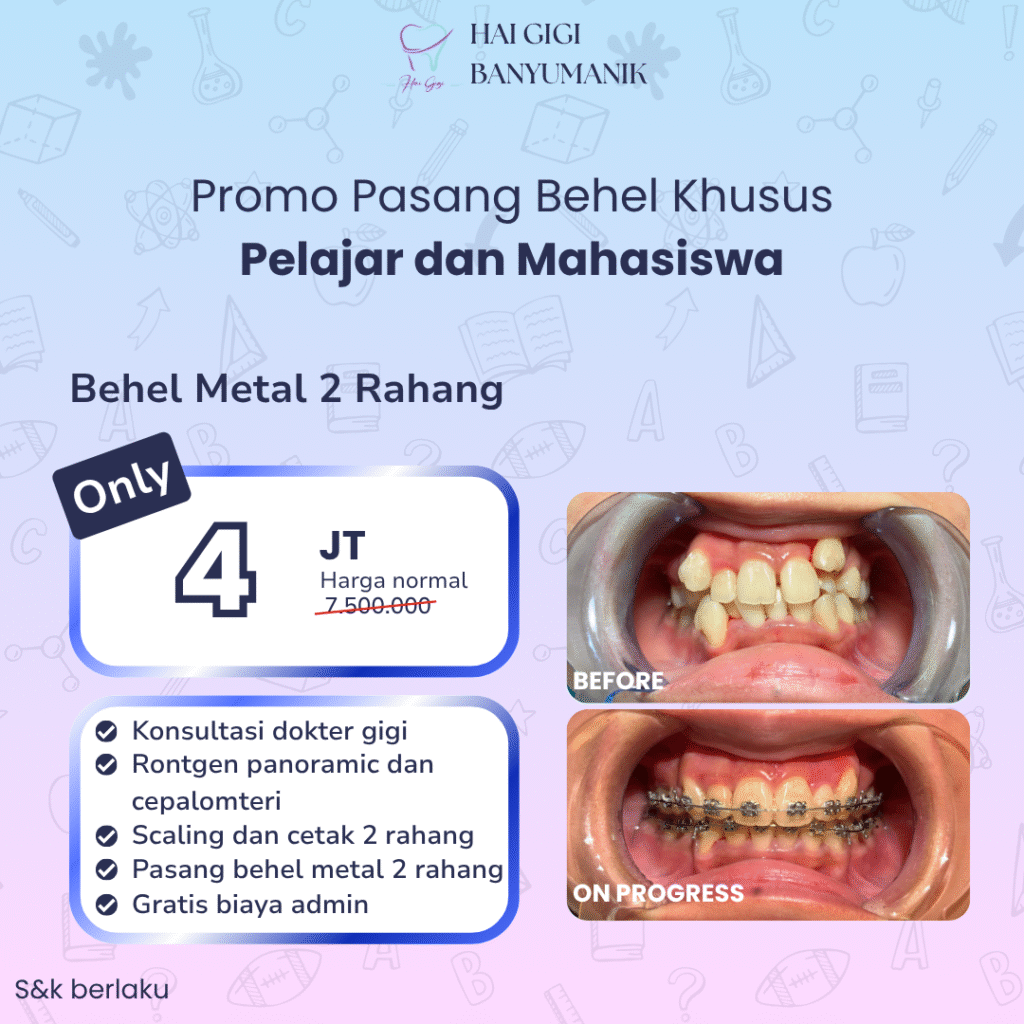 behel-pelajar-hai-gigi-banyumanik