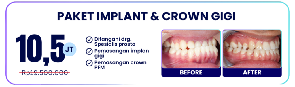 paket-implan-crown-hai-gigi-banyumanik
