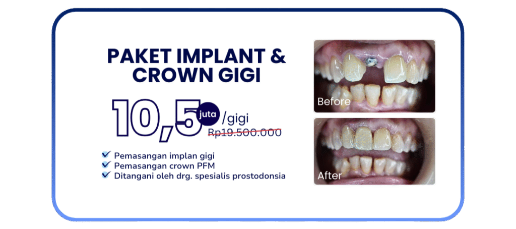 paket-implan-crown-hai-gigi-banyumanik