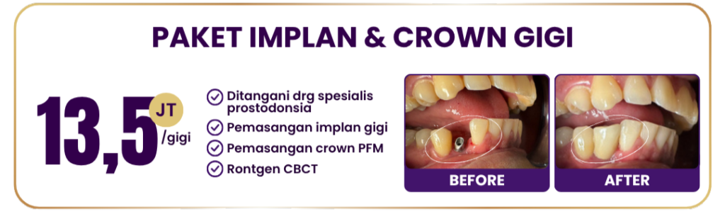 paket-implan-crown-hai-gigi-premier