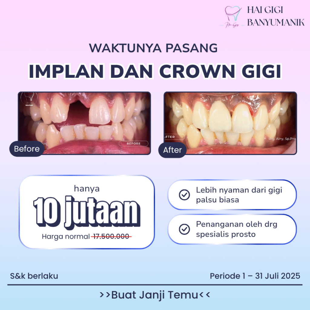 Implan Gigi paket-implan-dan-crown-gigi-hai-gigi-banyumanik