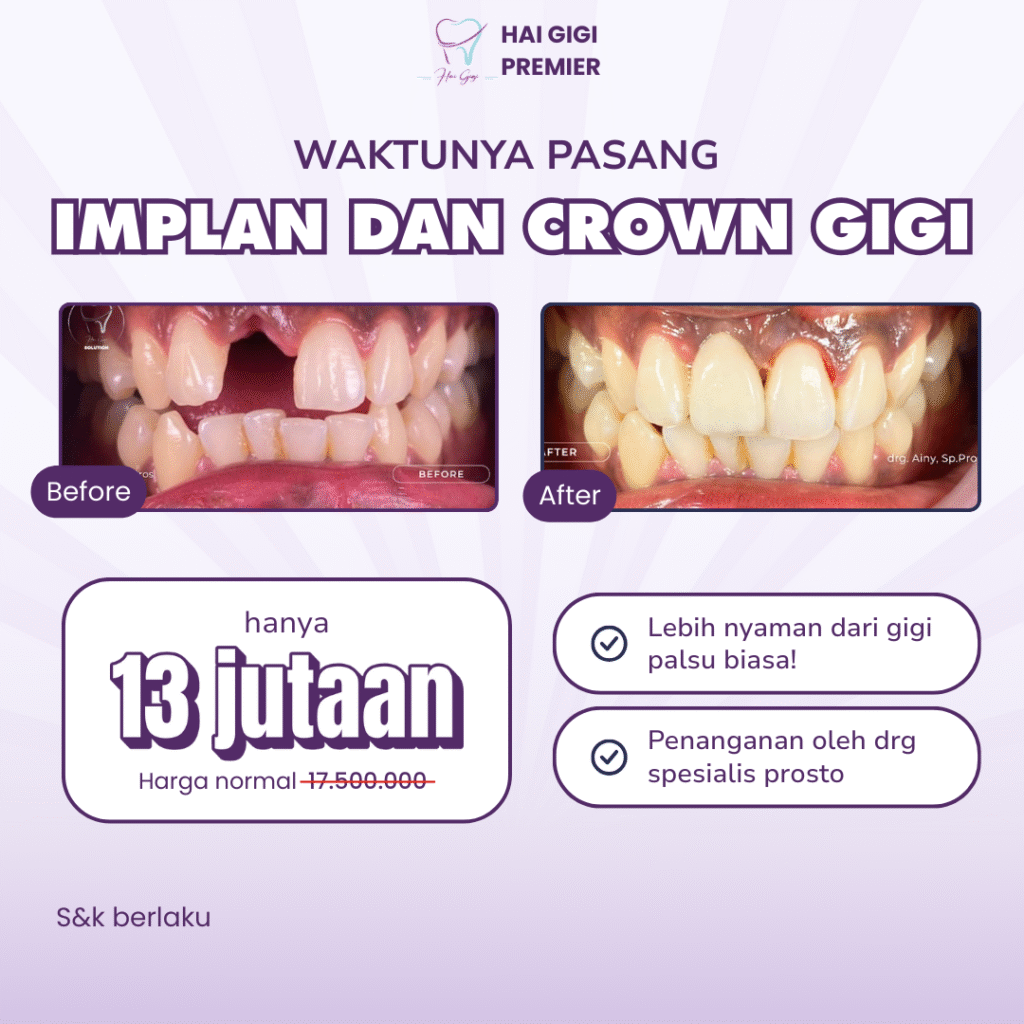 Promo Implan Gigi Promo Implan Gigi