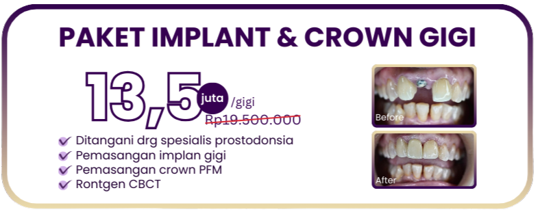 paket-implan-dan-crown-gigi-hai-gigi-premier