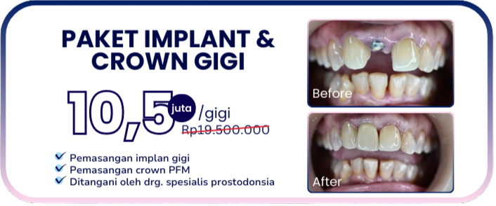 paket-implan-dan-crown-hai-gigi-banyumanik