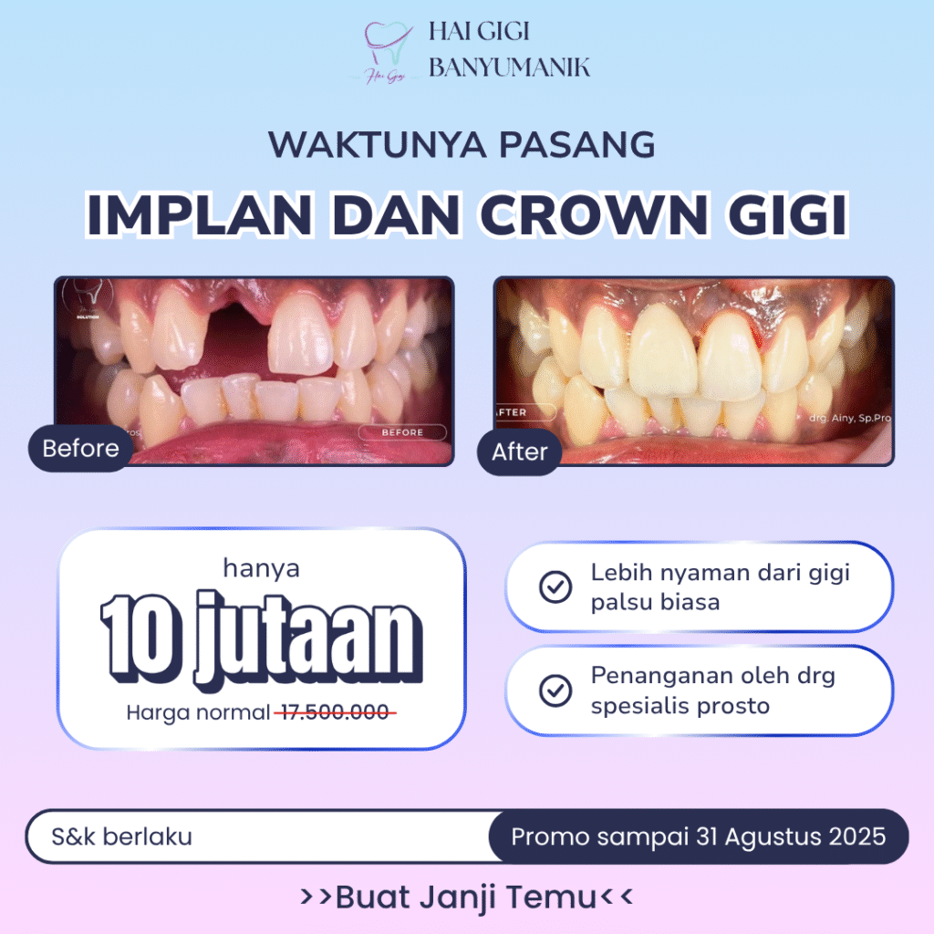 paket-implan-dan-crown-hai-gigi-banyumanik
