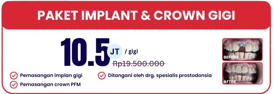 paket-implan-dan-crown-hai-gigi-banyumanik