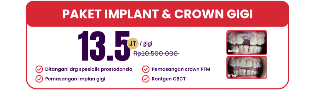 paket-implan-dan-crown-hai-gigi-premier