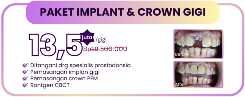 paket-implan-gigi-hai-gigi-premier