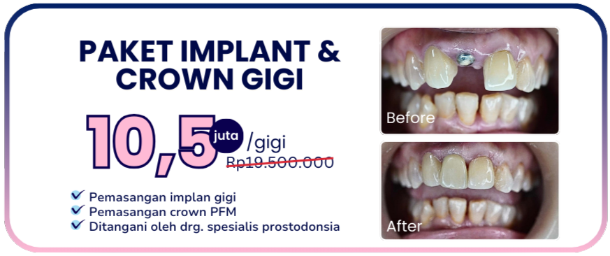 promo-hai-gigi-banyumanik-paket-implan-dan-crown-gigi