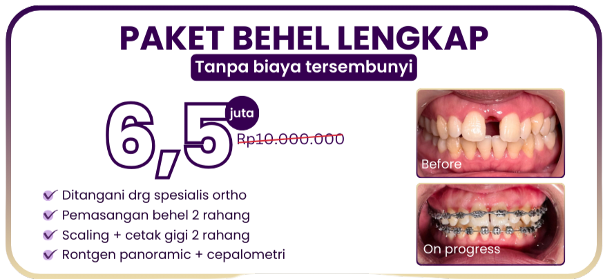 paket-behel-lengkap-hai-gigi-premier