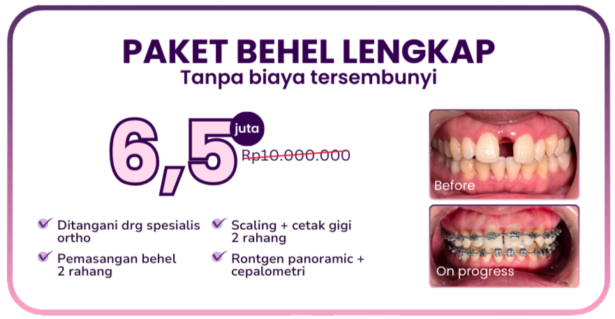 promo-hai-gigi-premier-paket-behel-lengkap