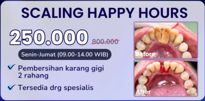 Scaling Gigi promo-scaling-happy-hours-hai-gigi-banyumanik
