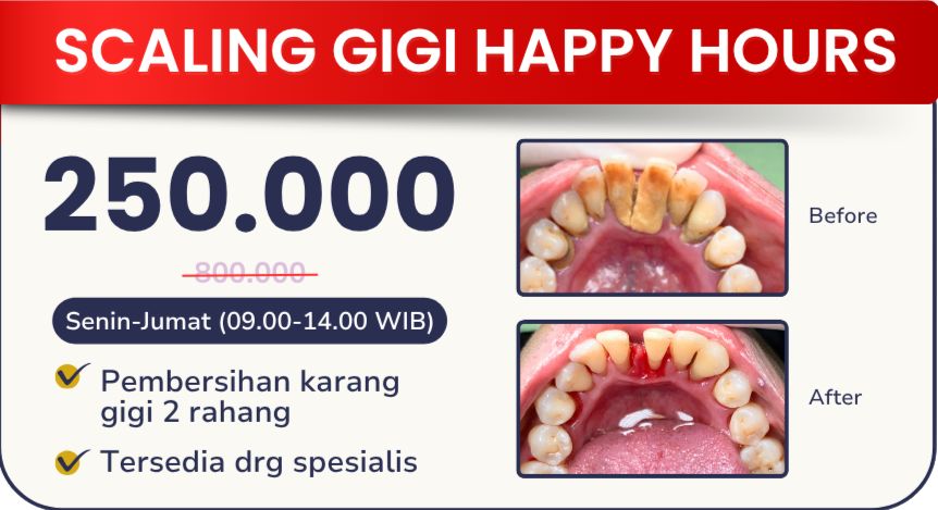 scaling-gigi-happy-hour-hai-gigi-banyumanik
