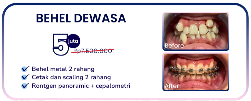 behel-dewasa-hai-gigi-banyumanik