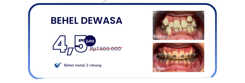 behel-dewasa-hai-gigi-banyumanik