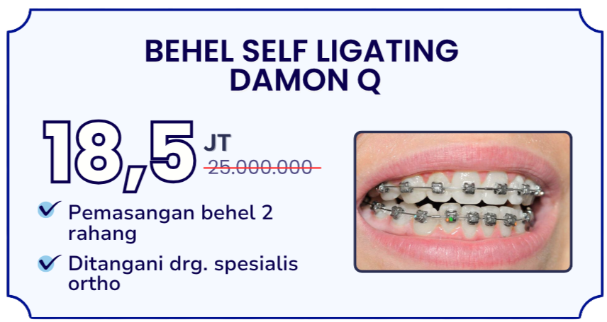 behel-self-ligating-damon-q-hai-gigi-banyumanik