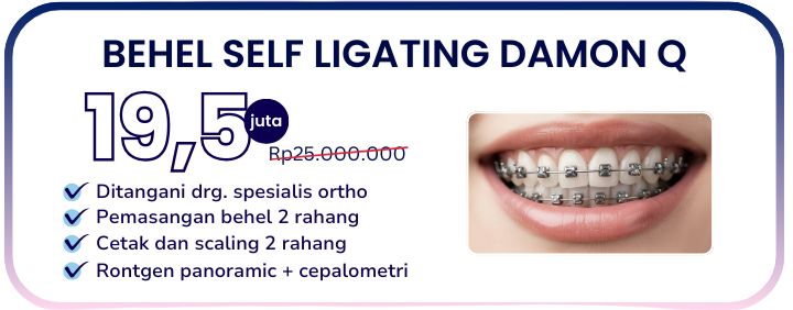 behel-self-ligating-damon-q-hai-gigi-banyumanik