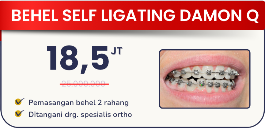 behel-self-ligating-damon-q-hai-gigi-banyumanik