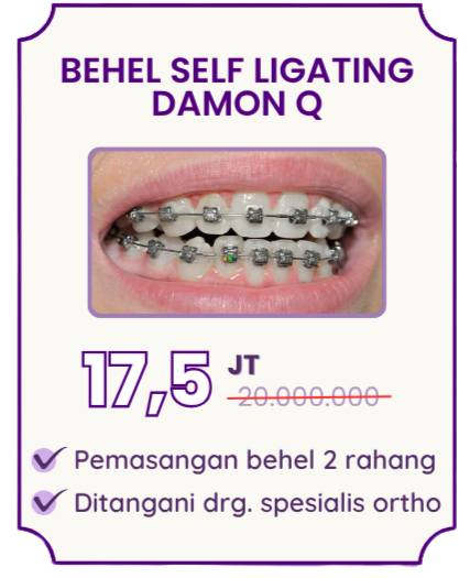 behel-self-ligating-damon-q-hai-gigi-premier