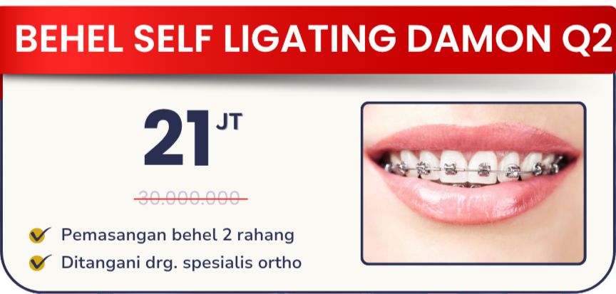 behel-self-ligating-damon-q2-hai-gigi-banyumanik