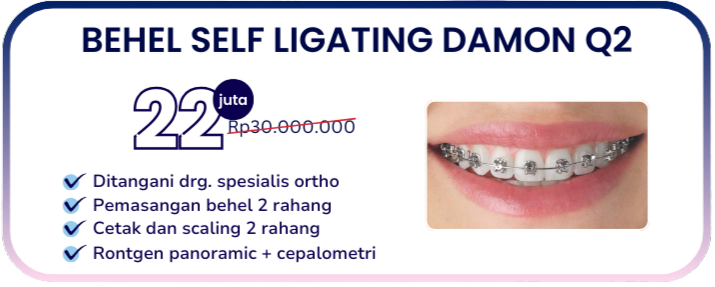 behel-self-ligating-damon-q2-hai-gigi-banyumanik