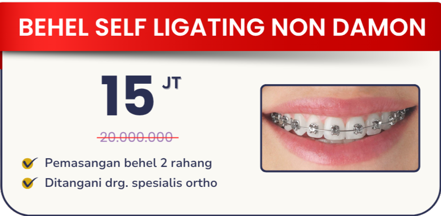 behel-self-ligating-non-damon-hai-gigi-banyumanik