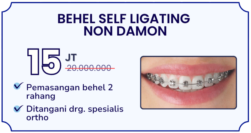 behel-self-ligating-non-damon-hai-gigi-banyumanik