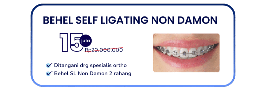 behel-self-ligating-non-damon-hai-gigi-banyumanik