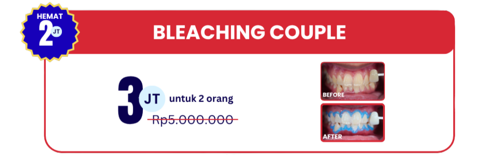 bleaching-couple-hai-gigi-banyumanik