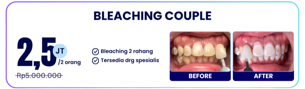 bleaching-couple-hai-gigi-banyumanik