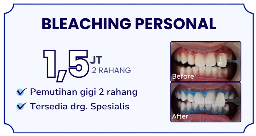 bleaching-gigi-hai-gigi-banyumanik