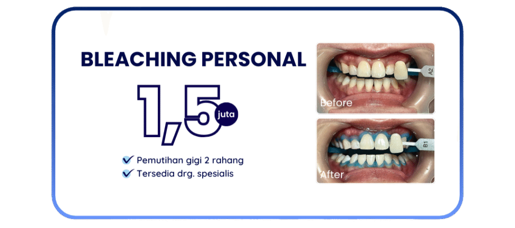 bleaching-personal-hai-gigi-banyumanik (1)