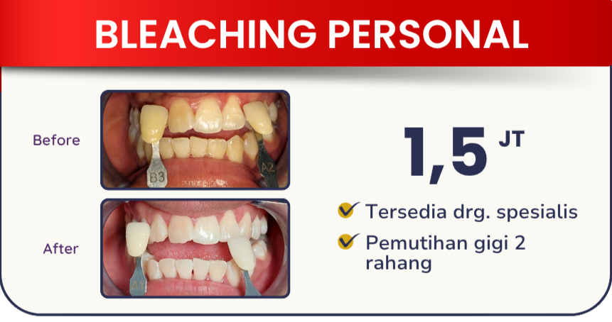 bleaching-personal-hai-gigi-banyumanik