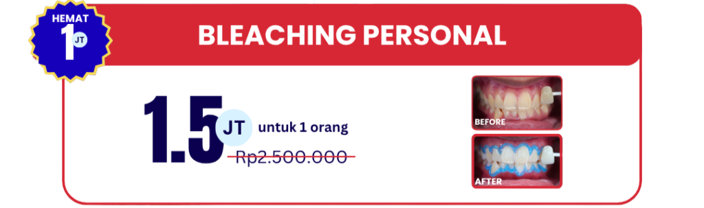bleaching-personal-hai-gigi-banyumanik