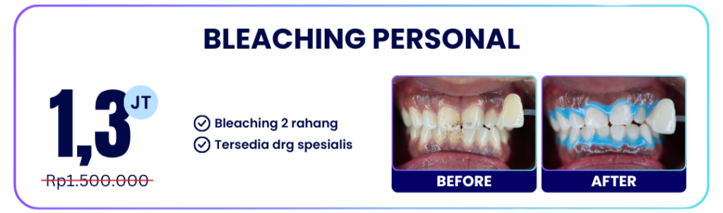 bleaching-personal-hai-gigi-banyumanik