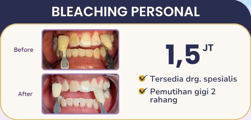 Bleaching Gigi bleaching personal hai gigi banyumanik