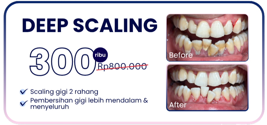deep-scaling-hai-gigi-banyumanik