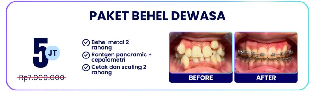 paket-behel-dewasa-hai-gigi-banyumanik