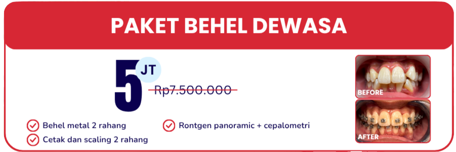 paket-behel-dewasa-hai-gigi-banyumanik