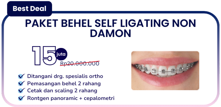 paket-behel-self-ligating-non-damon-hai-gigi-banyumanik