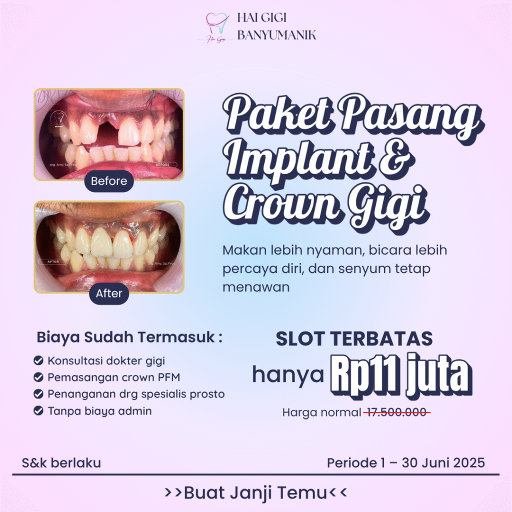 paket-pasang-implan-dan-crown-gigi-hai-gigi-banyumanik