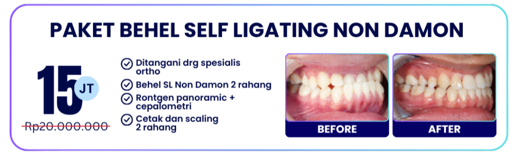 paket-self-ligating-non-damon