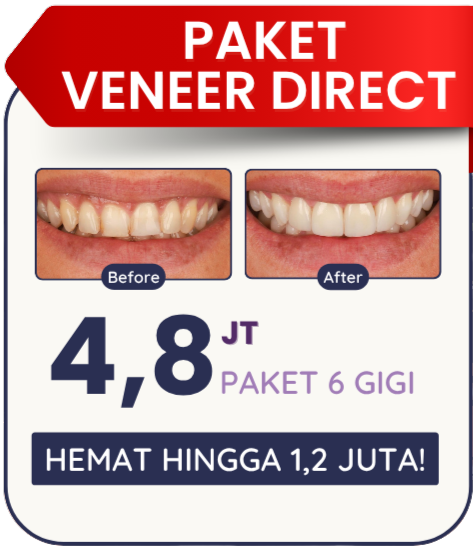 paket-veneer-direct-hai-gigi-banyumanik