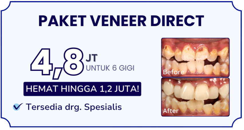 paket-veneer-direct-hai-gigi-banyumanik