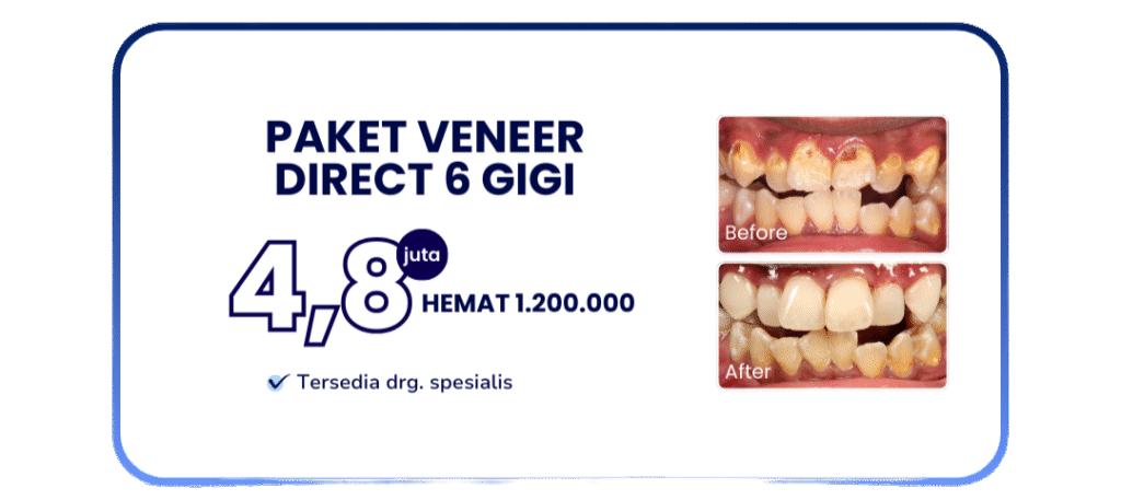 paket-veneer-direct-hai-gigi-banyumanik