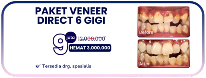 paket-veneer-direct-hai-gigi-banyumanik