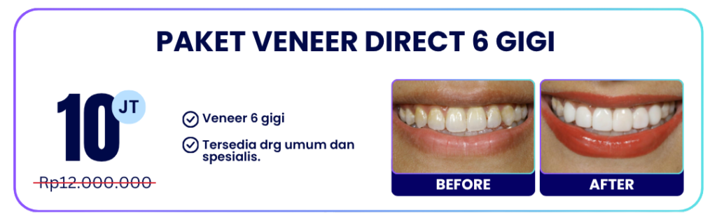 paket-veneer-direct-hai-gigi-banyumanik