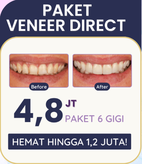 Veneer Gigi paket-veneer-direct-hai-gigi-banyumanik