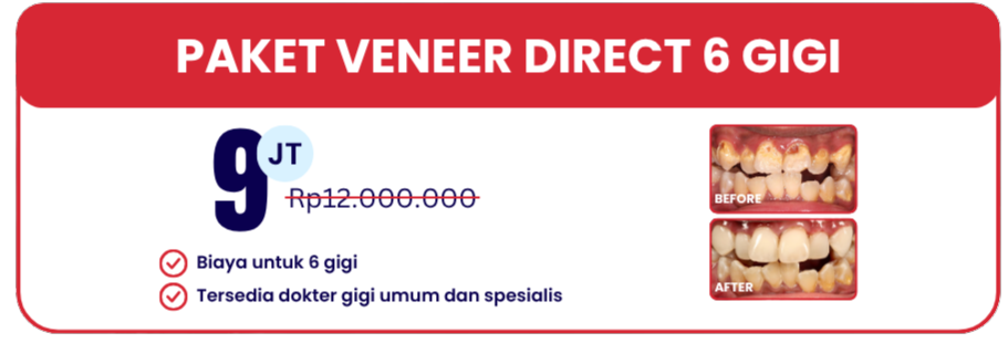 paket-veneer-hai-gigi-banyumanik
