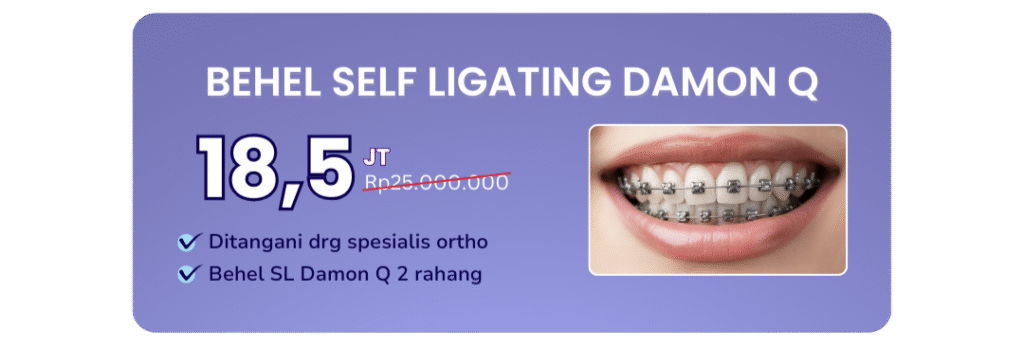 promo-behel-self-ligating-damon-q-hai-gigi-banyumanik